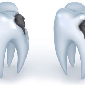 دانلود طرح جابر در مورد خراب شدن دندان